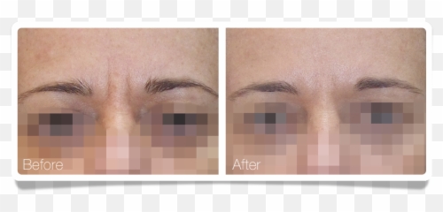 Clínica Áureo - WRINKLES BETWEEN THE EYEBROWS Eye Shadow png