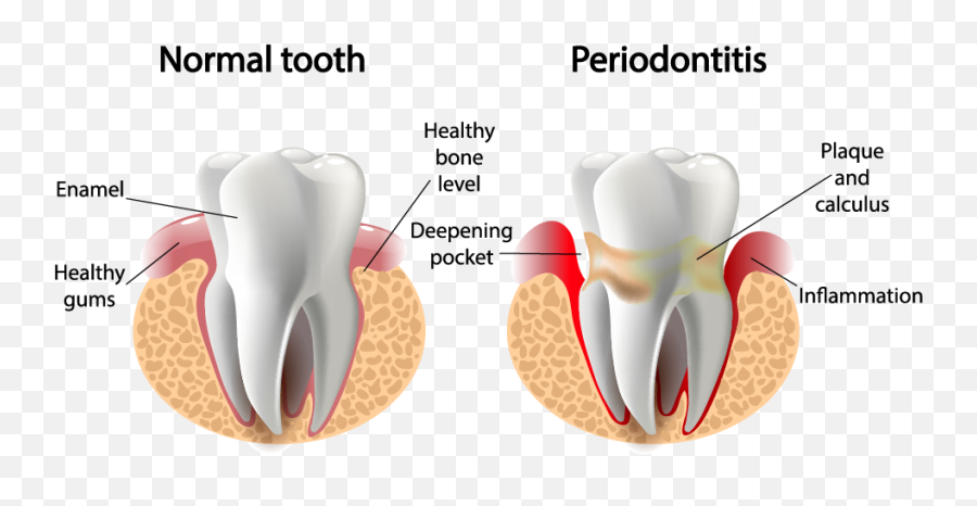 Risks And Causes Of Receding Gums - Periodontal Disease Png,Tooth Png