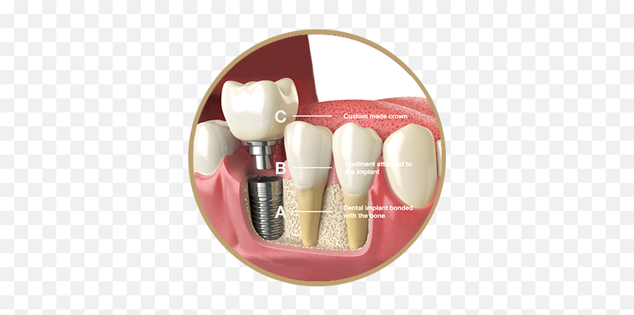 Services - Icon Dental Group Nogales Implant Teeth Png,Icon Tooth Treatment