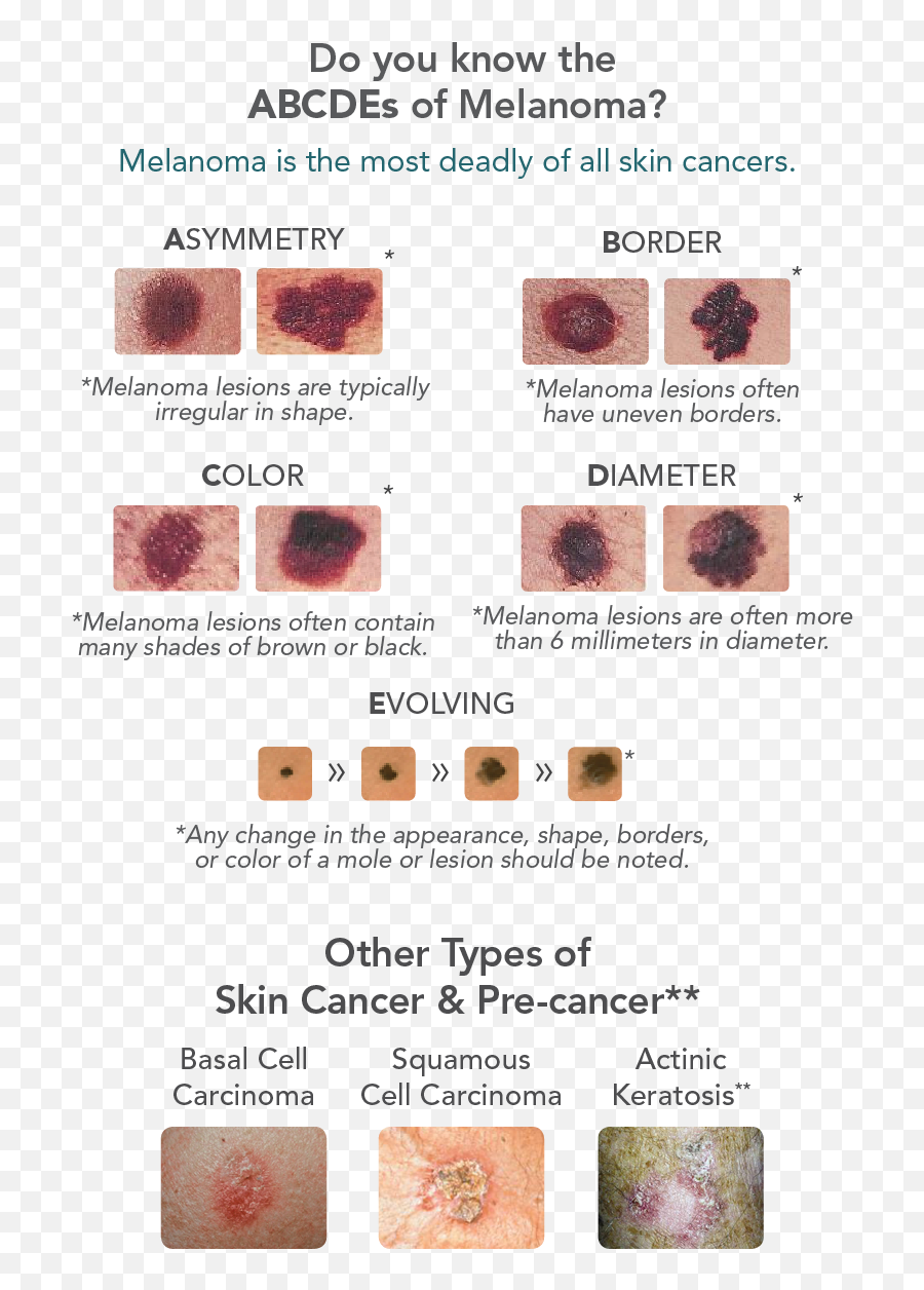 Skin Cancer Warning Signs Associates In Dermatology - Skin Cancer Warning Signs Png,Warning Sign Transparent