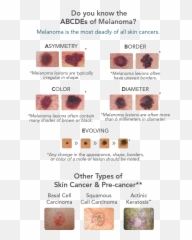 Skin Cancer Warning Signs Associates In Dermatology - png
