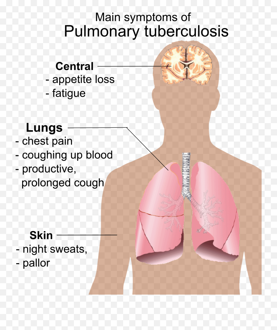 Pulmonary Tuberculosis Symptoms - Main Symptoms Of Pulmonary Tuberculosis Png,Could Png