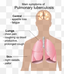 Pulmonary Tuberculosis Symptoms - Main Symptoms Of Pulmonary Tuberculosis Png,Could Png