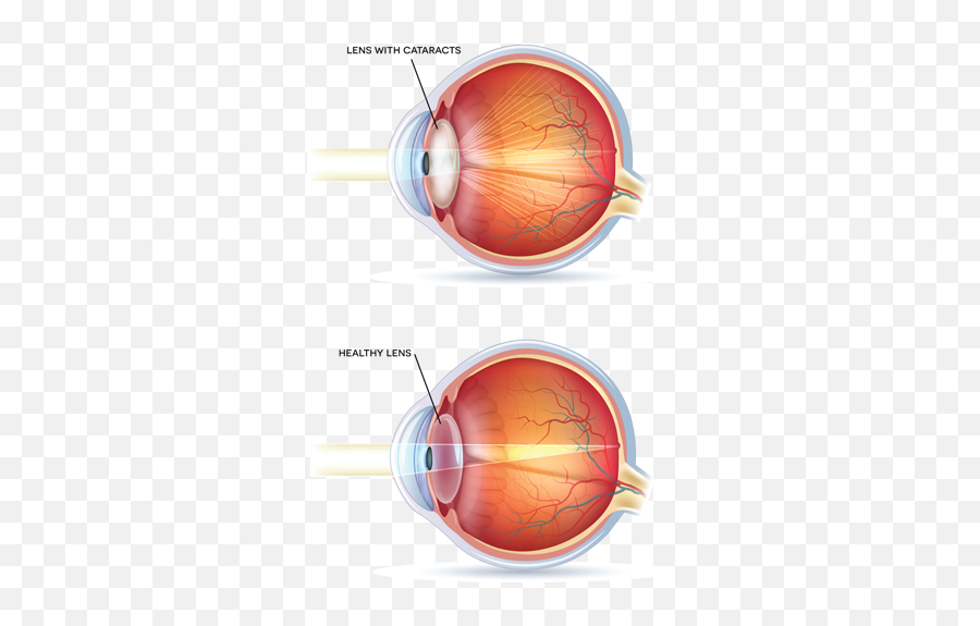 Cataracts - Lens Of The Eye Png,Eye Transparent