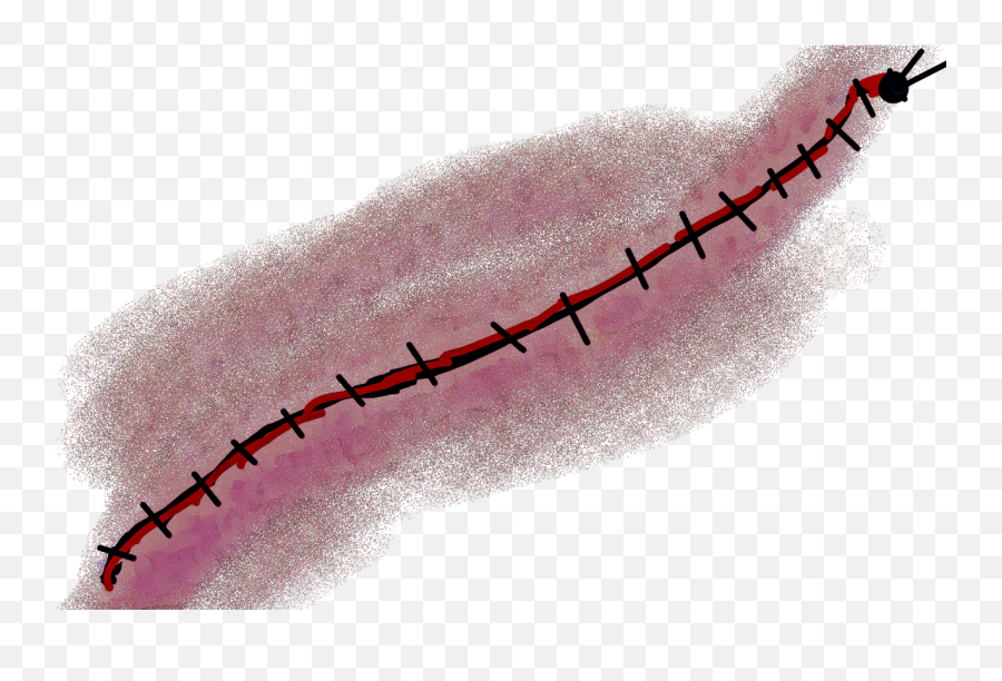 And White Scars Transparent Stitch - Scar With Stitches Transparent Png,Stitches Png