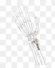 Bone Radius - Placa Acu Loc 2 Png,Skelton Png