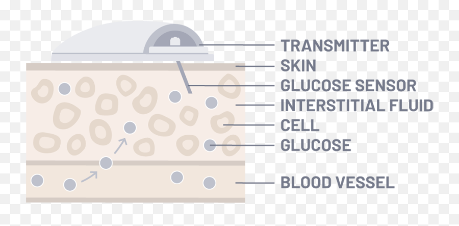 Thinking Smaller To Manage Diabetes With Continuous Glucose - Continues Glucose Monitoring System Needle Png,Glucose Meter Icon