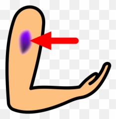 Picture - Bruise Clipart Png,Bruise Png
