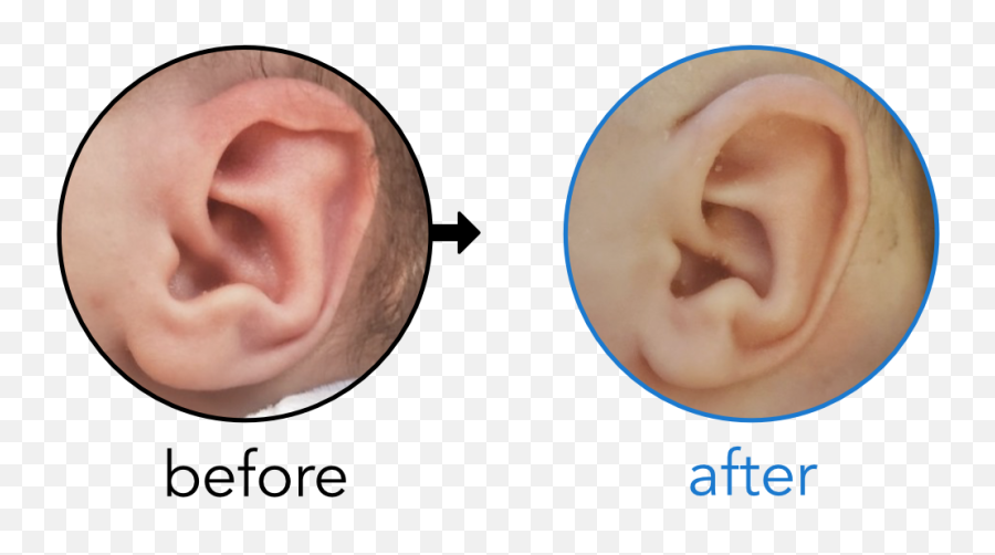 Before U0026 Afters Earbuddies Permanent Solution To Stick - My Ears Stick Out Png,Elf Ear Png