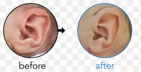 Before U0026 Afters Earbuddies Permanent Solution To Stick - My Ears Stick Out Png,Elf Ear Png