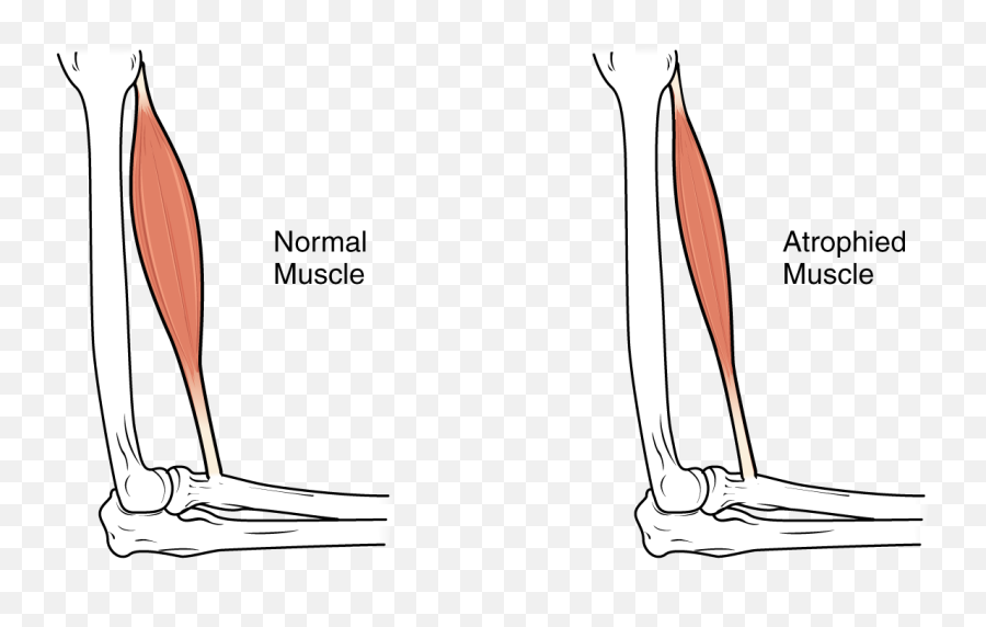 Medical Bed For Muscular Dystrophy - Muscle Atrophy Vs Hypertrophy Png,Muscle Png