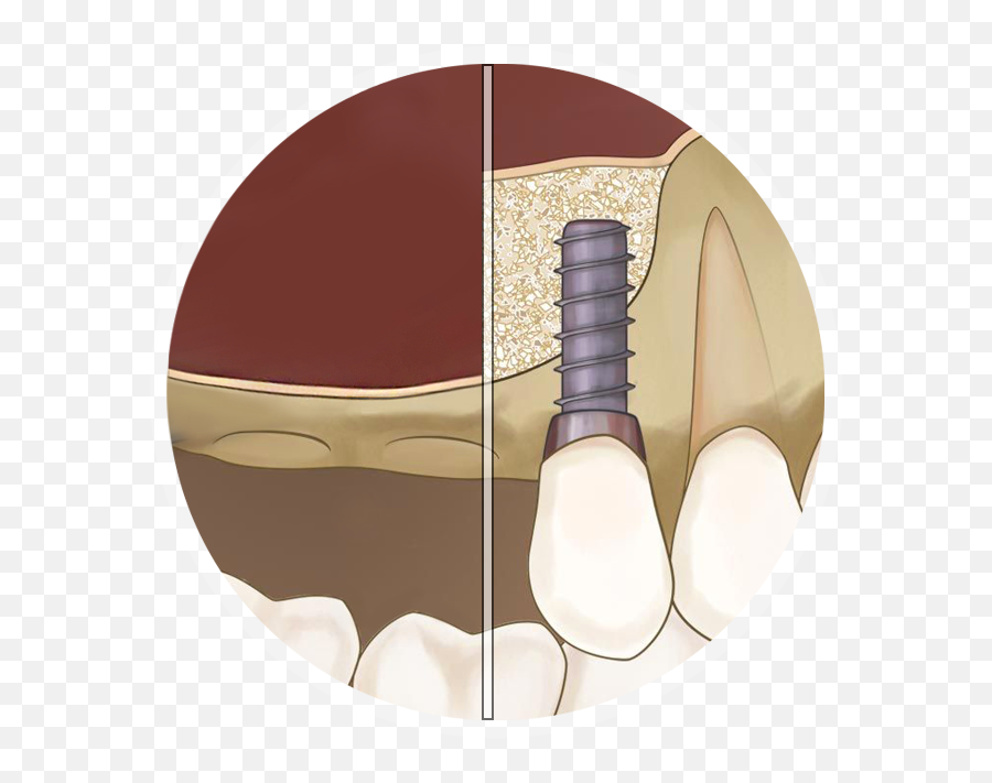 Sinus Lift - Medical Png,Icon Lifts