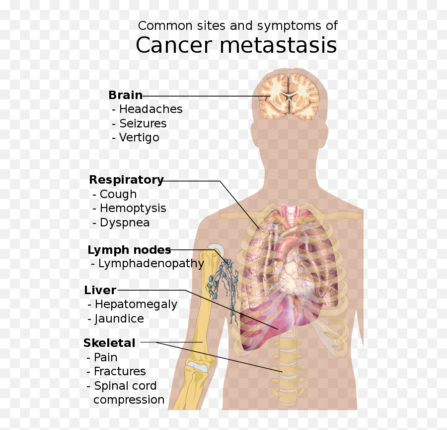 Cancer - Wikiwand Common Sites And Symptoms Of Cancer Metastasis Png,Dennert Icon