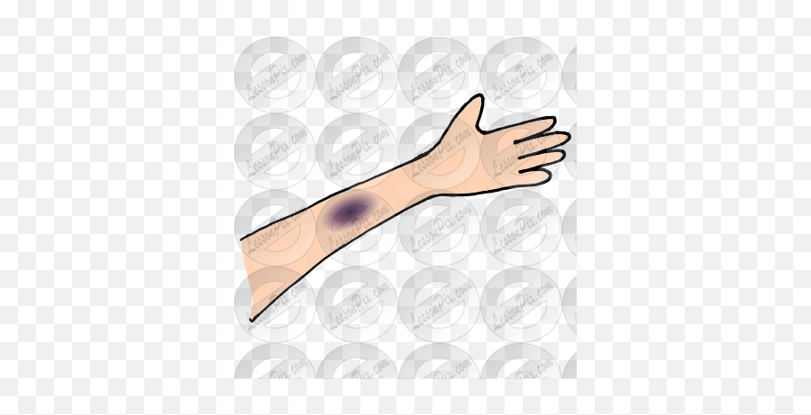 Bruise Picture For Classroom Therapy - Hand Png,Bruise Png