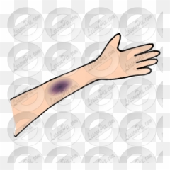 Bruise Picture For Classroom Therapy - Hand Png,Bruise Png