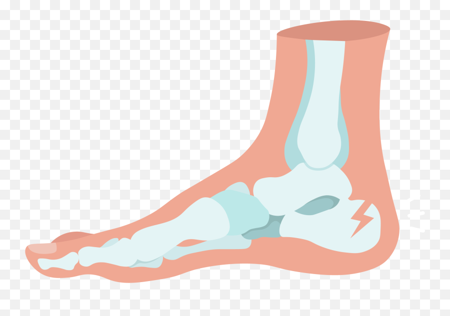 Calcaneus Fracture Treatments Path To Healing U0026 Causes Buoy - Drawing Png,Broken Bone Icon