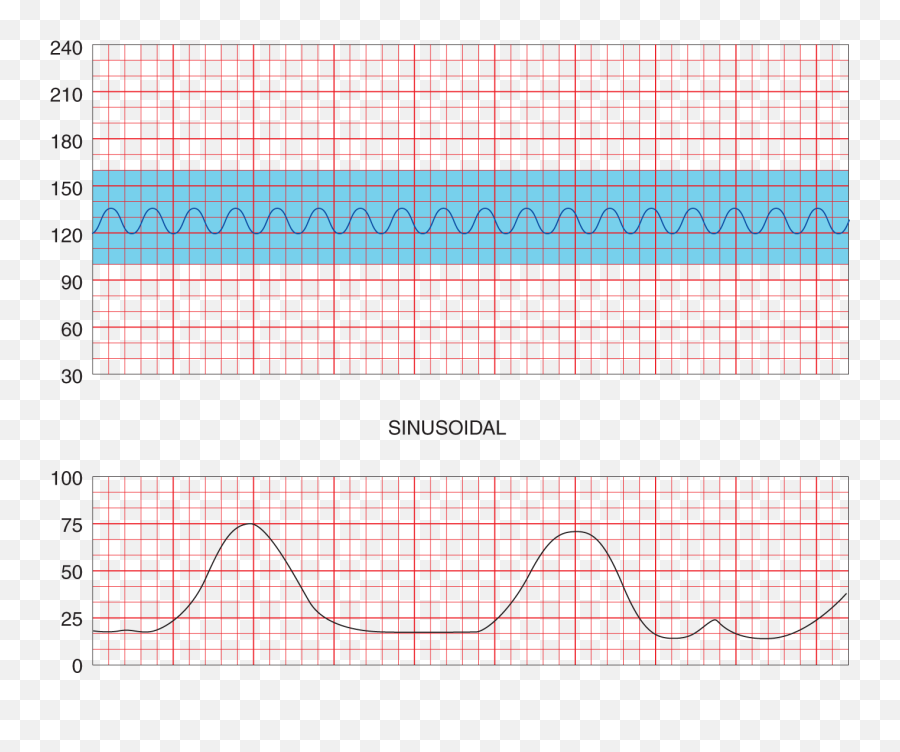 Deceleration In The Fetal Heart Rate - Plot Png,Heart Rate Png