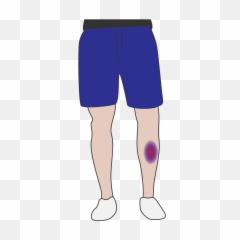Bruising Clipart Knee Download Board - Bruise Clipart Black And White Png,Bruise Png