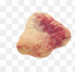 Bruise - Transparent Bruising Png,Bruise Png