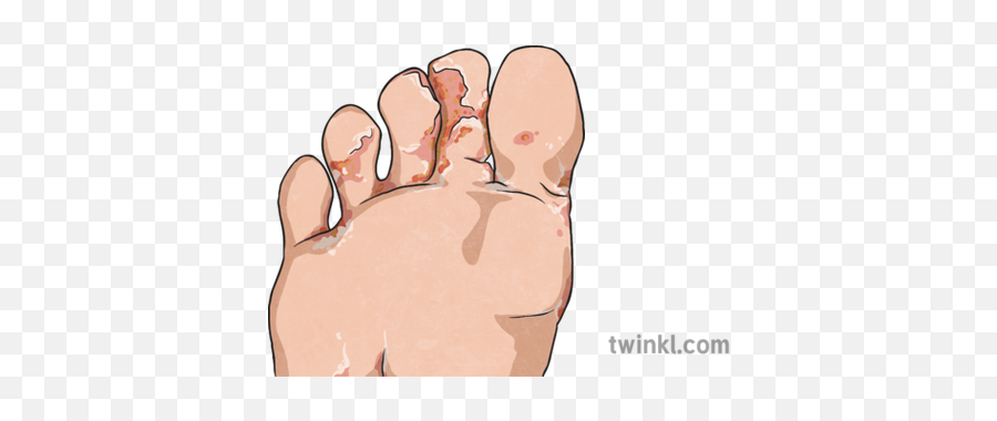 Athletes Foot Illustration - Foot Png,Foot Png