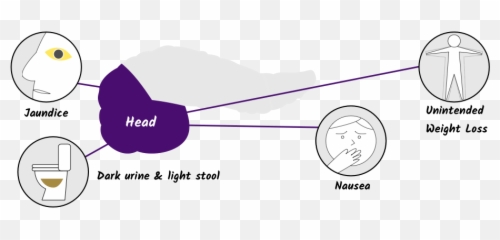 Symptoms Of Pancreatic Cancer - Language png