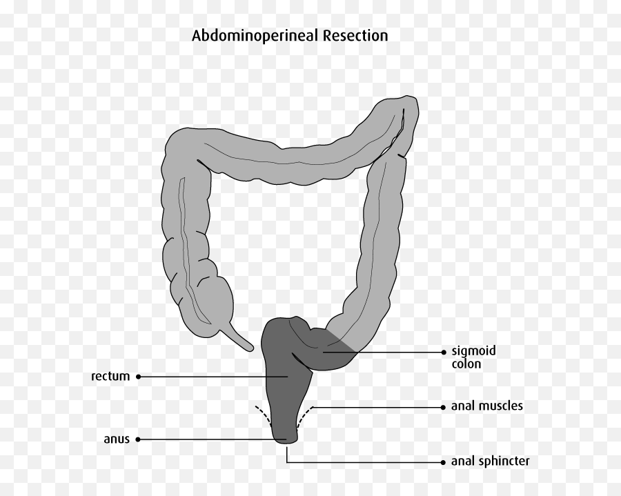 Abdominoperineal Resection In South Africa Costs Doctors - Abdominoperineal Rectal Resection Png,Soweto Icon Vector