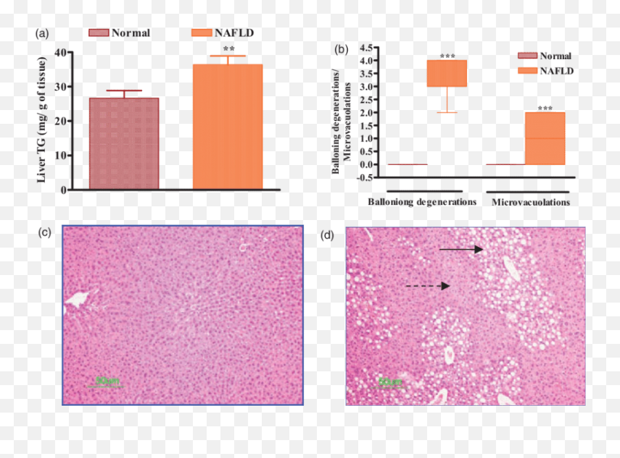 A Elevation In Liver Triglyceride Tg Levels By Dietary - Screenshot Png,Liver Png