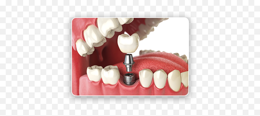 Expert Dental Implants In Ewa Beach Hi Laulani Care - Implante Dental Png,Tooth Png