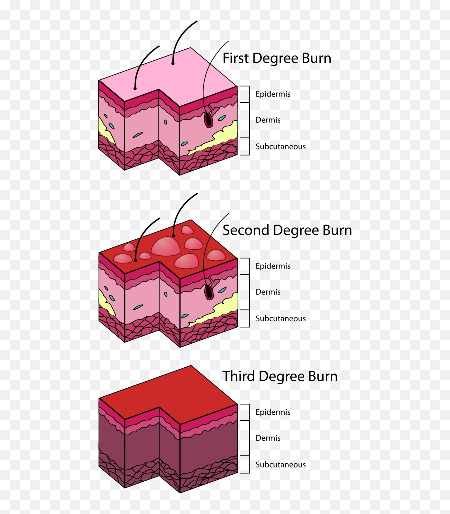 Burn Degree Diagram - Three Classifications Of Burns Png,Burn Mark Png
