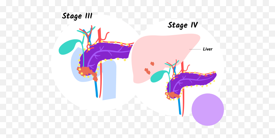 Stages Of Pancreatic Cancer - Pancreatic Cancer Stafe 4 Png,Pancreas Icon