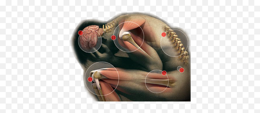 First Asco Guidelines For Chronic Pain In Cancer Survivors - Congenital Analgesia Png,Pain Png