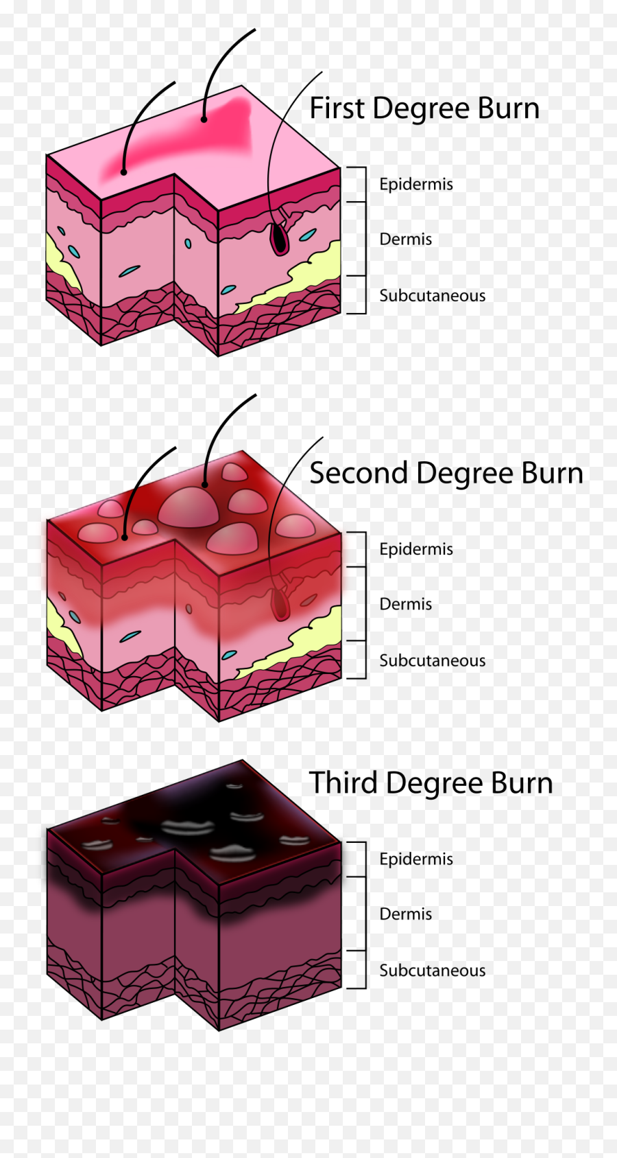 Burn Degree Diagram - Should I Put A Bandaid On A Burn Png,Burn Png