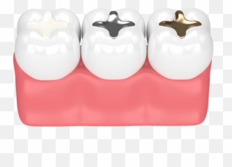 Dental Fillings Alta Austin Tx - Types Of png