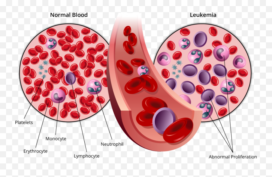 Blood Cells Png - Stages Of Leukemia Blood Cancer Acute Leukemia,Cells Png