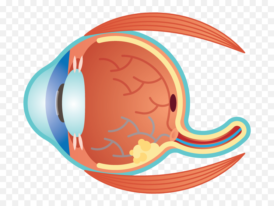 Retinoblastoma - Eye Health Consultants Retinal Detachment Scleral Buckling Png,Anatomy Icon