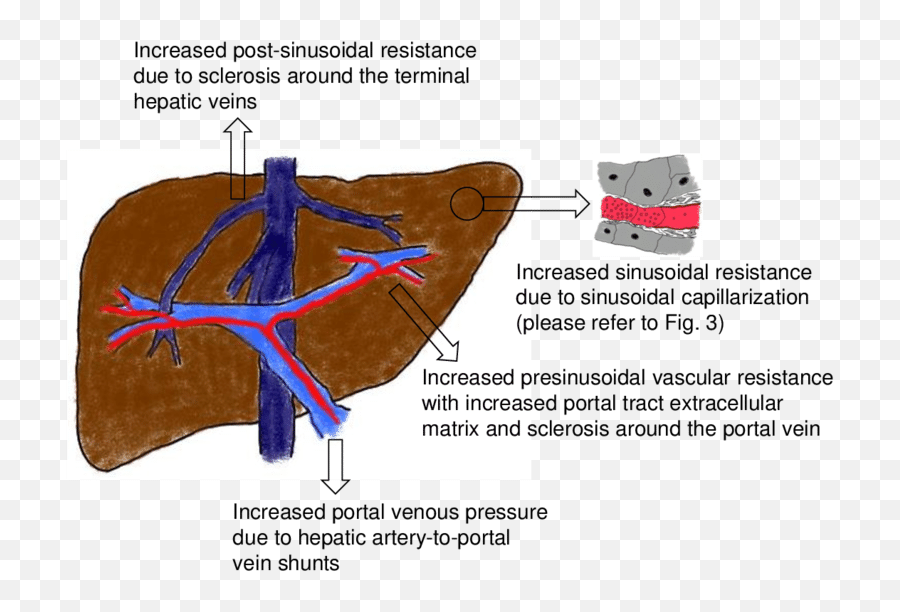 Alterations In Hepatic Hemodynamics A Cirrhotic Liver - Hepatic Venous Outflow Obstruction Png,Liver Png