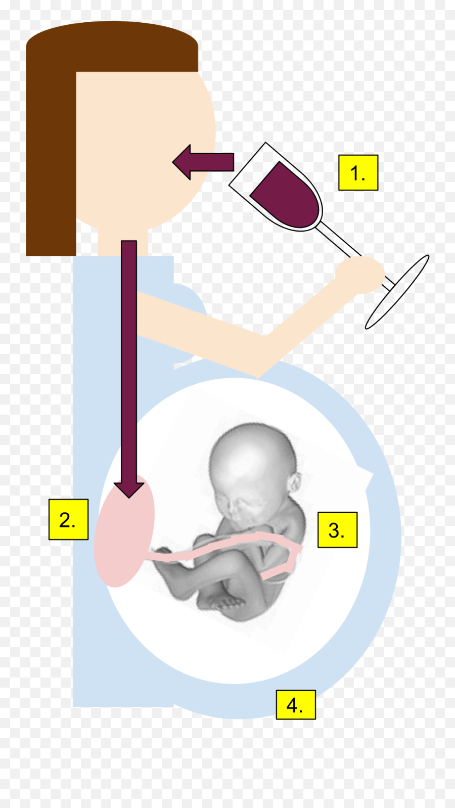 Filefetal Alcohol Syndromesvg - Wikimedia Commons Fetal Alcohol Syndrome Png,Fetus Png