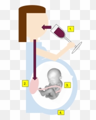 Filefetal Alcohol Syndromesvg - Wikimedia Commons Fetal Alcohol Syndrome Png,Fetus Png