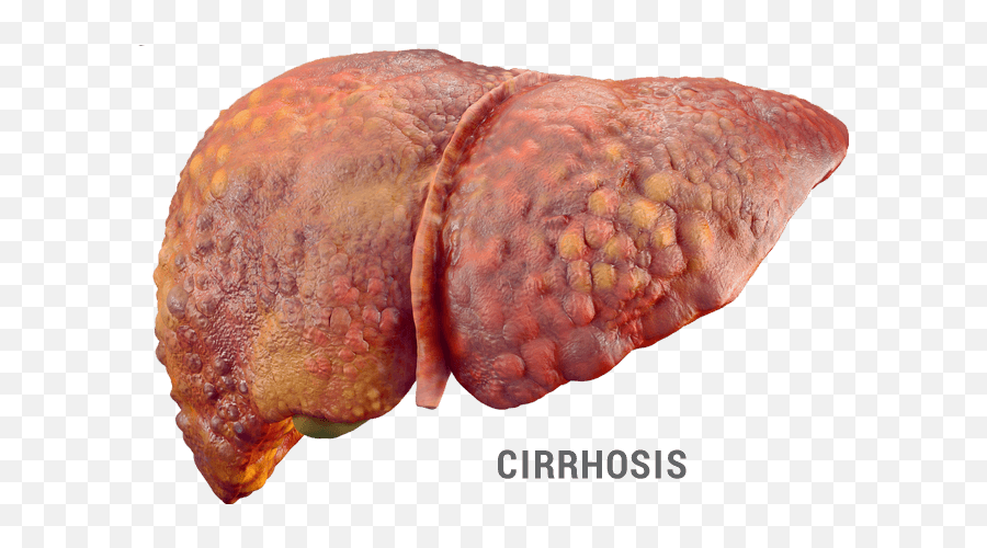 What Is Hepatic Encephalopathy He Xifaxan Rifaximin - Fatty Liver Hepatitis Png,Liver Png