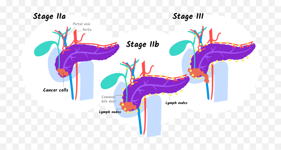 Stages Of Pancreatic Cancer - Managing Pancreatic Cancer Stage 1 Pancreatic Cancer Stages Png,Pancreas Icon