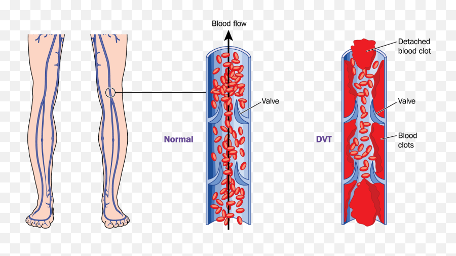 What Is Deep Vein Thrombosis - Deep Vein Thrombosis And Pulmonary Embolism Png,Vein Png