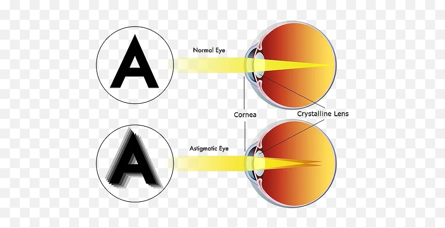 Astigmatism - Astigmatism Eyeglasses Png,Eye Glare Png
