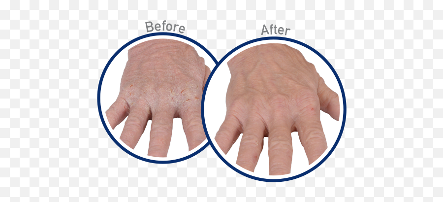 Ou0027keeffesu0027s Eczema Relief Hand Cream - Does Hand Eczema Look Like Png,Eczema Icon