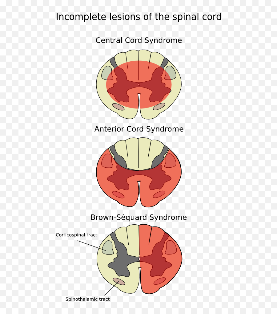 Cord - Incomplete Spinal Cord Lesions Png,Cord Png