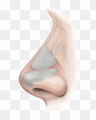 Latera - Dissolvable Stents In Nose png