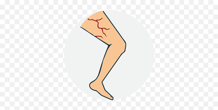 Download Hd Varicose Vein - Illustration Transparent Png Clip Art,Vein Png