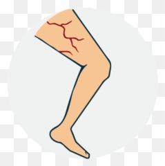 Download Hd Varicose Vein - Illustration Transparent Png Clip Art,Vein Png