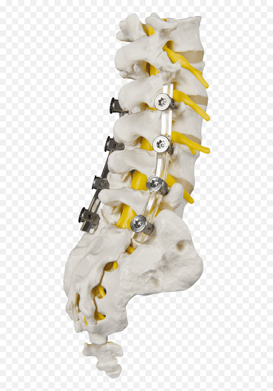 Dynamic Stabilization For Your Back - Spineshape El Implante De Columna Que Se Adapta A La Patología Del Paciente Png,Spine Png