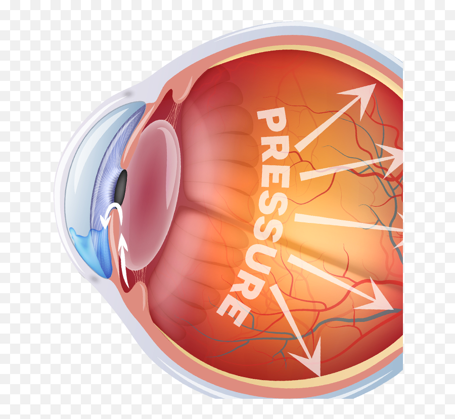 Types Of Glaucoma - Chicago Il Primary Eye Care Associates Glaucoma Transparent Png,Eye Glare Png