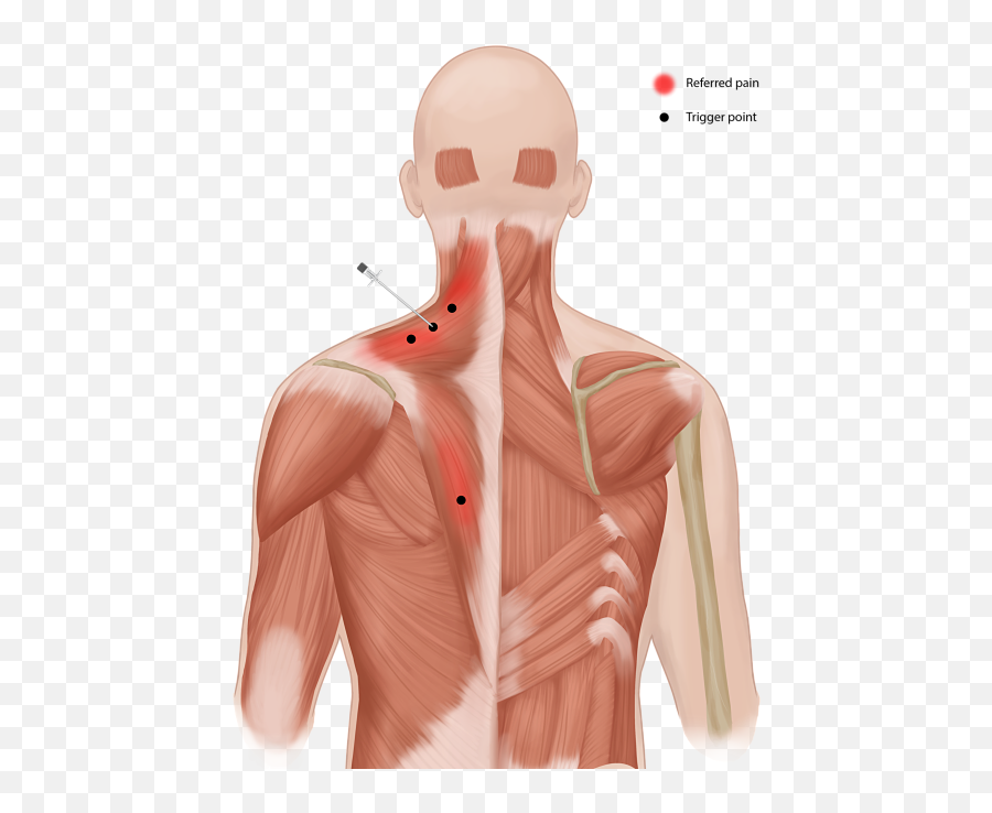 Procedures Offered U2014 East End Pain Management - Trigger Point Injections Neck Png,Pain Png